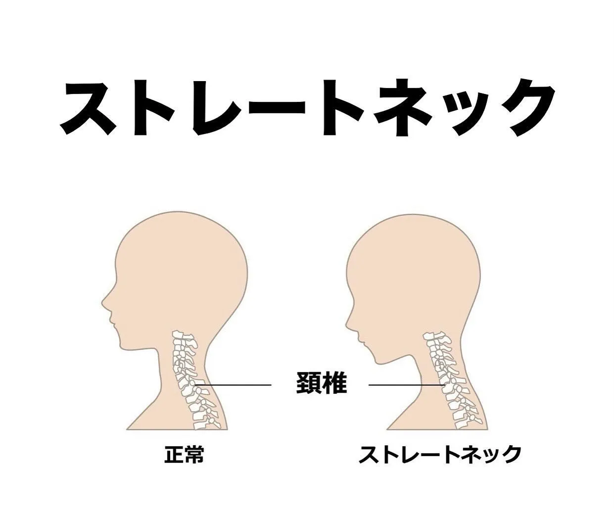 ストレートネックでは、持続的な頭部の前方突出によって上位頚椎...