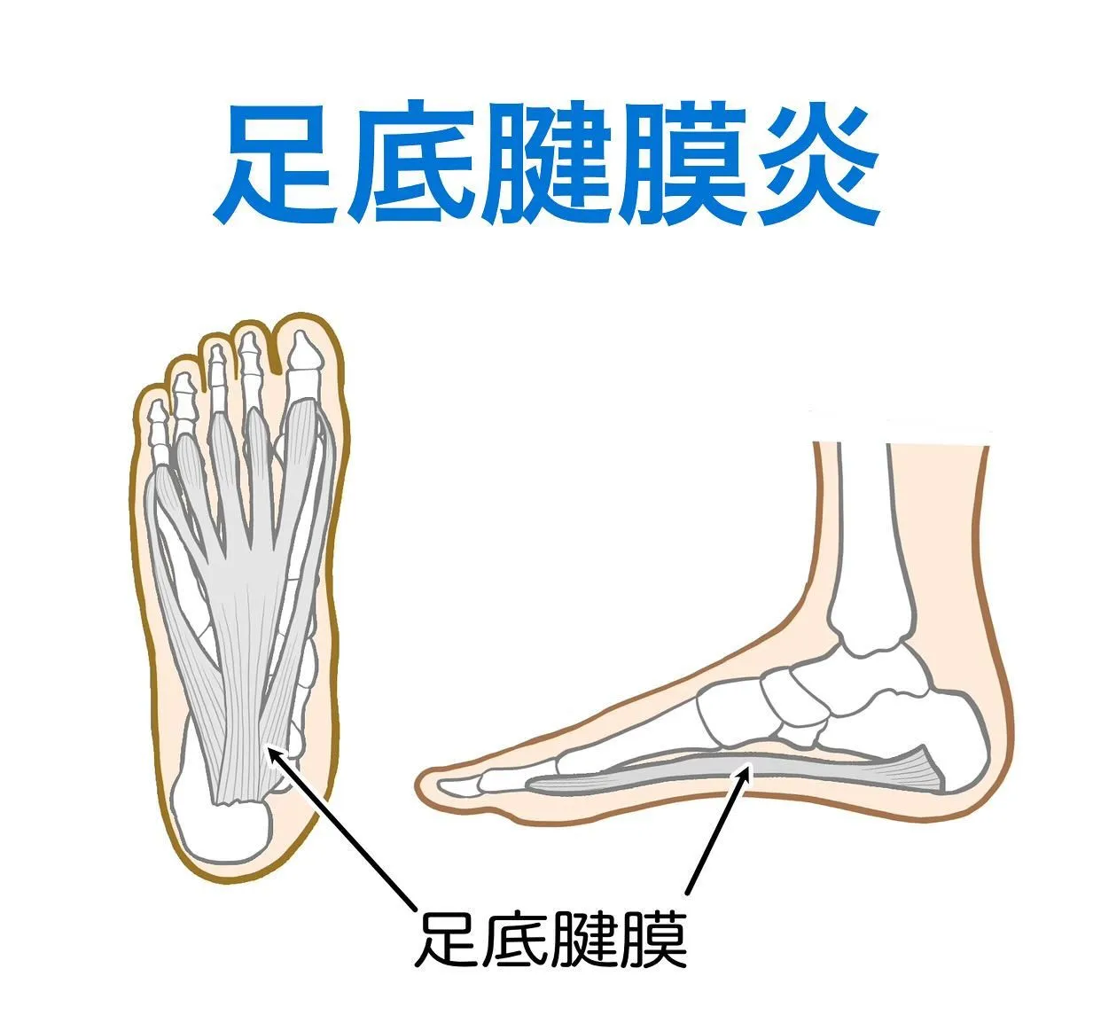 足底腱膜炎は足関節の回内が強くなることで扁平化が進行し発生し...